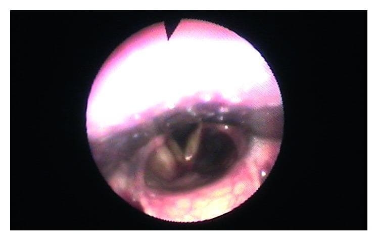 This clinical photograph shows a fiberoptic laryngoscopy view of the human larynx, specifically highlighting the glottis and surrounding supraglottic structures. The true vocal folds are clearly visible, appearing symmetrical and pale-white with normal morphology, and are positioned centrally without displacement. The ventricular folds (false vocal cords) are situated laterally to the true folds. A localized area of slight rosaceous or erythematous coloration is visible on the left ventricular fold, representing a minor residual inflammatory or vascular change. The overall anatomical placement of the larynx is midline and stable, indicating the resolution of any previous lateral pharyngeal wall bulging or endolaryngeal displacement. This image serves as a follow-up diagnostic tool to assess the laryngeal recovery and structural integrity in a patient post-treatment for cervical or parapharyngeal pathologies.