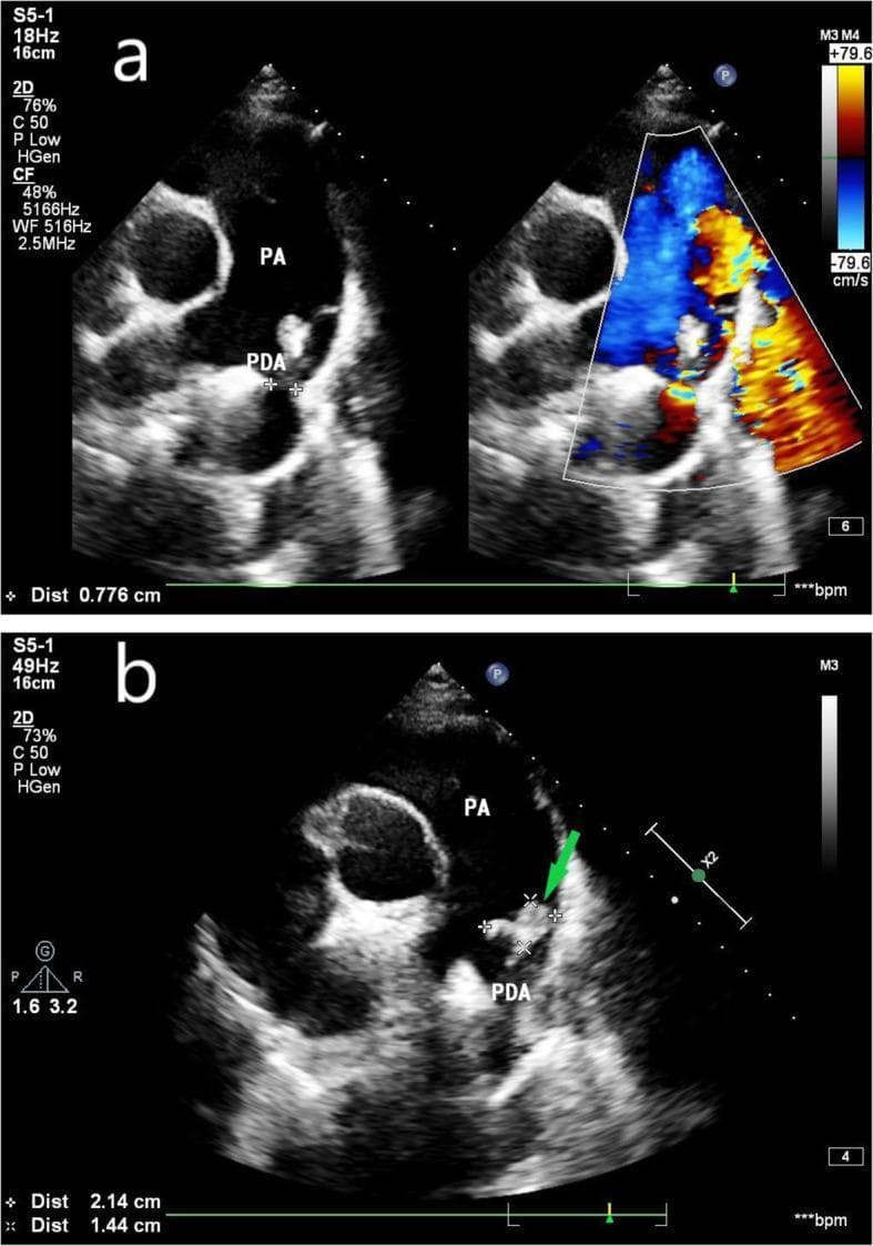 Two-panel fetal echocardiogram at 26 weeks of gestation demonstrating a patent ductus arteriosus (PDA) complicated by infective endocarditis (IE). Panel A features side-by-side 2D grayscale and color Doppler images. The grayscale view identifies the pulmonary artery (PA) and a PDA channel measuring 0.776 cm. The color Doppler demonstrates the left-to-right shunt of the artery through the ductus. Panel B provides a magnified grayscale view of the PDA opening, where a green arrow indicates an irregular, hyperechoic mass. This mass, measuring approximately 2.14 cm by 1.44 cm, represents a vegetation consistent with infective endocarditis. The imaging illustrates the characteristic anatomical connection between the pulmonary artery and the descending aorta in a PDA case, with the added clinical complication of vegetative growth on the vessel wall. This content is suitable for advanced cardiology and maternal-fetal medicine education regarding congenital heart disease and obstetric infections.