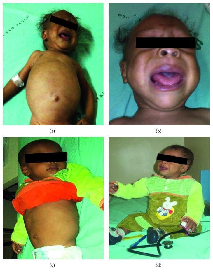 A series of four clinical photographs (a–d) documenting the progression of a pediatric patient with primary congenital hypothyroidism before and after treatment. Images (a) and (b) represent the patient at admission, exhibiting classic symptoms of untreated hypothyroidism: severe abdominal distension (pseudo-obstruction secondary to constipation), an umbilical hernia, generalized myxedema, and visible irritability. Facial features in (b) show macroglossia (enlarged tongue), rarefied eyebrows, and brittle, sparse hair. Images (c) and (d) depict the same patient six months after initiating levothyroxine sodium replacement therapy. These images demonstrate significant clinical improvement, including the complete resolution of abdominal distension (c) and achievement of developmental milestones, such as sitting without support (d). The comparison illustrates the systemic effects of thyroid hormone deficiency on metabolism, gastrointestinal motility, and neurodevelopmental progress in infants, as well as the efficacy of hormonal replacement.