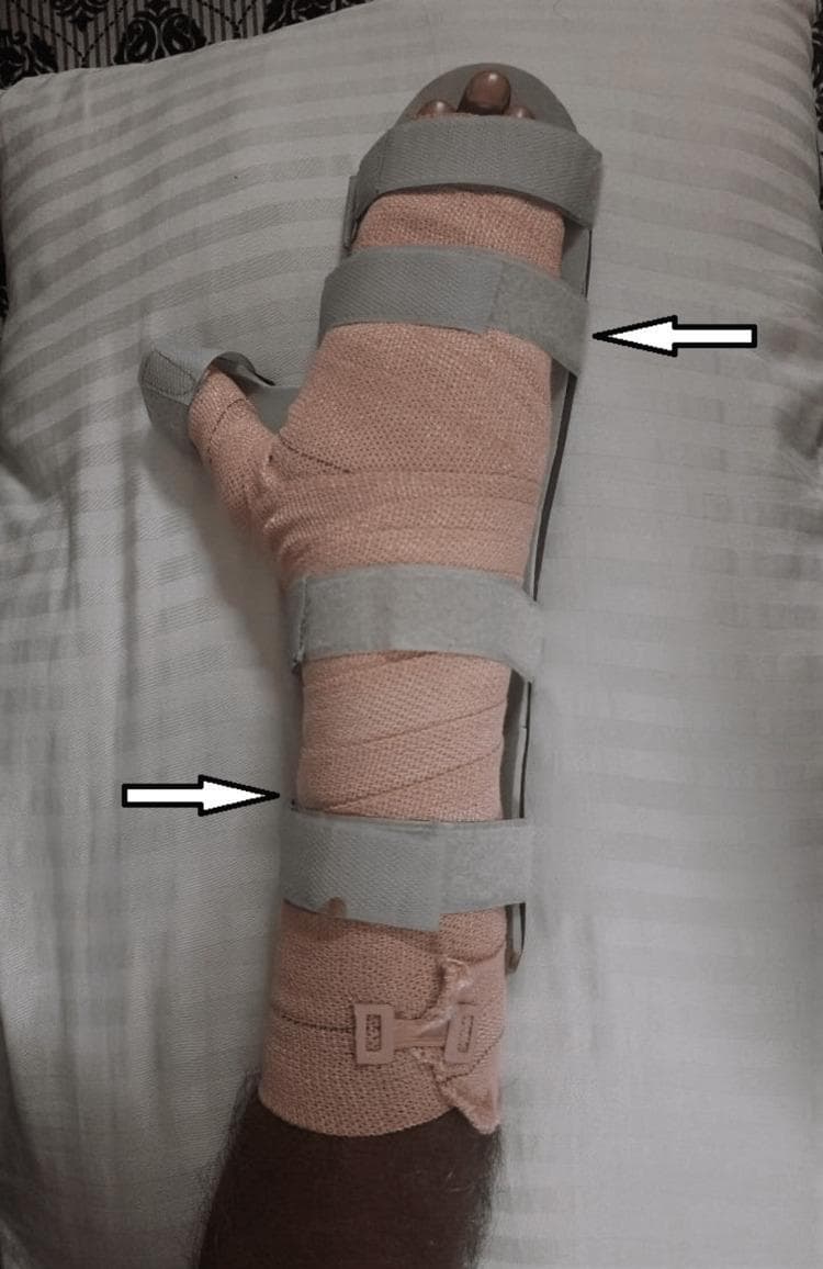 A clinical photograph of a patient's forearm and hand demonstrating a cock-up splint for the rehabilitation of a burn injury. The visual depicts a rigid dorsal support structure extending from the mid-forearm to the metacarpophalangeal joints, maintaining the wrist in a neutral or slightly extended position to prevent contracture. The limb is wrapped in a light peach-colored elastic crepe bandage that covers the forearm and hand, providing compression for edema management. The thumb is partially wrapped but remains in a functional position. The entire assembly is secured by four wide, gray hook-and-loop (Velcro) straps positioned at the proximal forearm, wrist, mid-palm, and distal phalanges. The fingertips are visible at the distal end of the splint to allow for neurovascular monitoring. This clinical application is typical for physical therapy management of second-degree (deep partial-thickness) burns to prevent deformity and maintain range of motion.