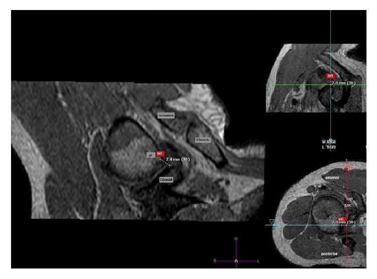 Multi-planar MRI of a human shoulder joint, displayed in coronal (large left panel), sagittal (top right), and transverse (bottom right) planes to illustrate internal impingement mechanisms. The imaging depicts the shoulder in the Neer position (170° elevation), which is utilized to evaluate the spatial relationship between humeral and scapular structures. In the coronal view, anatomical labels identify the acromion, clavicle, and glenoid. A red measurement marker, labeled 'M1', is positioned at the minimum distance between the greater tuberosity (gt) of the humerus and the superior glenoid rim, showing a quantified distance of 7.4 mm. The sagittal and transverse slices reinforce this spatial assessment, with the transverse view specifically identifying the anterior aspect of the humeral head and the subscapularis (SSC) tendon. This diagnostic visualization is intended to demonstrate the close proximity of the greater tuberosity to the glenoid during provocative maneuvers, relevant for studying internal shoulder impingement syndromes and rotator cuff pathology.