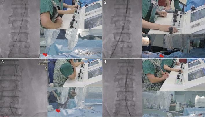 This composite clinical figure illustrates four key stages of a robotic-assisted Endovascular Aortic Repair (EVAR) for an abdominal aortic aneurysm. Each quadrant (1–4) combines real-time fluoroscopic imaging of the lumbar spine and vasculature with photographs of the operator's remote console and the robotic functional unit at the patient's bedside.