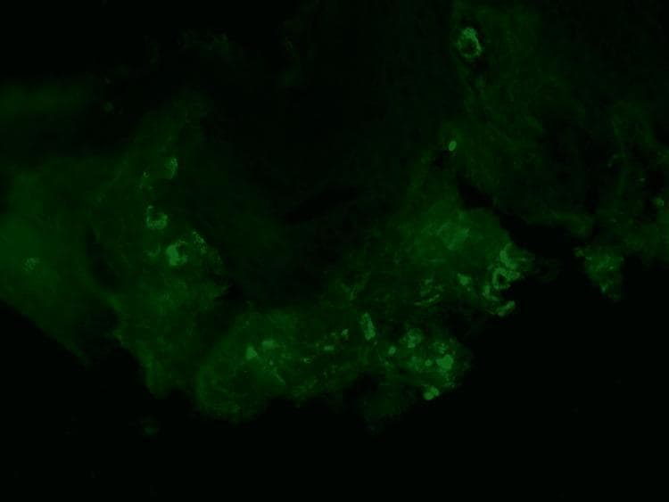 This diagnostic image demonstrates direct immunofluorescence (DIF) of a skin punch biopsy specimen. The micrograph reveals a characteristic granular green fluorescent staining pattern against a dark background. These fluorescent deposits are primarily concentrated in a perivascular distribution, localized around the superficial dermal blood vessels. The morphology of the staining is punctate and clumped, typical of immune complex deposition. Clinically, this visual evidence of perivascular IgA deposition is a hallmark diagnostic feature of IgA vasculitis (formerly Henoch-Schönlein purpura). The image illustrates the classic immunopathologic findings associated with leukocytoclastic vasculitis involving the small vessels of the dermis. This material is suitable for dermatology and rheumatology education, specifically for teaching the diagnostic criteria of systemic small-vessel vasculitides.