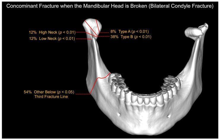 Anatomical Diagram and Statistical Map: This 3D medical illustration depicts a human mandible from a postero-superior perspective, detailing the distribution and frequency of concomitant fractures in the setting of bilateral mandibular condylar process fractures. The diagram specifically maps fracture patterns occurring when at least one fracture involves the mandibular head. Red anatomical lines indicate specific fracture sites: Type A (8%) and Type B (38%) fractures within the mandibular head, as well as High Neck (12%) and Low Neck (12%) fractures. A prominent 'Third Fracture Line' (54%) is illustrated extending through the mandibular body and ramus, highlighting the high incidence of additional injuries outside the condylar processes in complex bilateral trauma. Statistical significance (p-values) for each distribution is annotated. This educational visual is intended for maxillofacial surgery and traumatology training, illustrating the common patterns of associated fractures in patients with mandibular head involvement.
