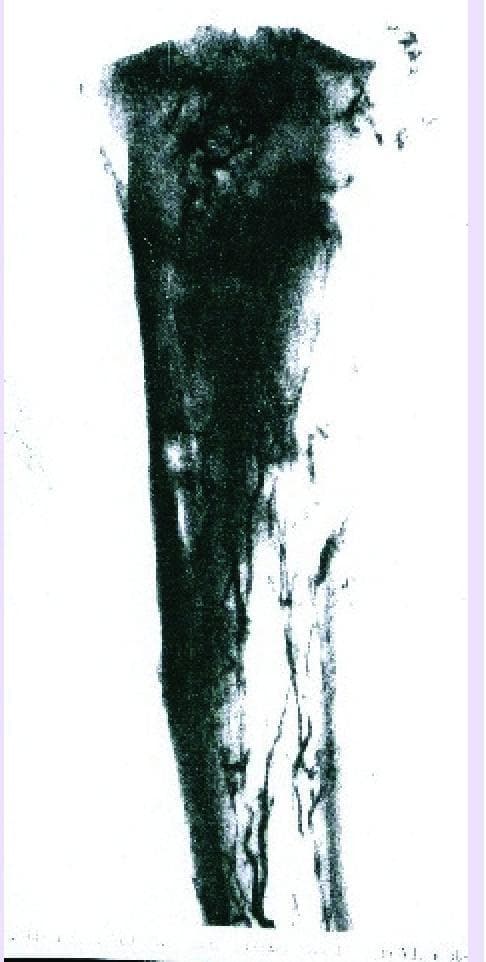 This diagnostic image is an angiogram illustrating the arterial vascularization of the proximal extremity of a human tibia. The image highlights the complex circulatory patterns essential for bone health and regeneration. The diaphyseal region demonstrates an arterial supply primarily derived from the nutrient artery, visible as a prominent, longitudinal vessel within the medullary canal. In contrast, the epiphyseal and metaphyseal regions show a more diffuse and intricate network of finer vessels. These arise from periosteal, capsular, and ligamentous sources, providing collateral circulation to the joint-adjacent structures. The contrast-enhanced vessels appear as dark, branching linear structures against the dense silhouette of the mineralized bone. This visualization is clinically relevant for understanding bone graft integration, the pathophysiology of osteonecrosis, and the healing of complex fractures or pseudarthrosis where vascular integrity is paramount for osteogenesis and remodeling.