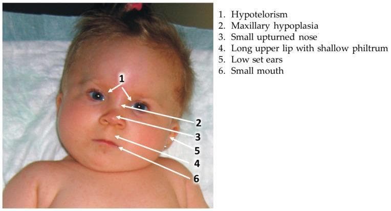 Clinical photograph of an infant demonstrating facial dysmorphism characteristic of Fetal Valproate Syndrome (VPA syndrome) or Antiepileptic Drug Syndrome. The image includes numerical annotations (1–6) highlighting specific diagnostic features: 1) Hypotelorism, indicated by decreased distance between the eyes; 2) Maxillary (midface) hypoplasia, evidenced by a flat nasal bridge; 3) A small, upturned nose; 4) A long, thin upper lip accompanied by a shallow, poorly defined philtrum; 5) Low-set ears; and 6) A small mouth with downturned angles. The educational focus is on the teratogenic effects of prenatal valproic acid exposure on craniofacial development. This visual serves as a reference for clinical genetics and pediatrics in identifying the phenotype of antiepileptic drug embryopathy.