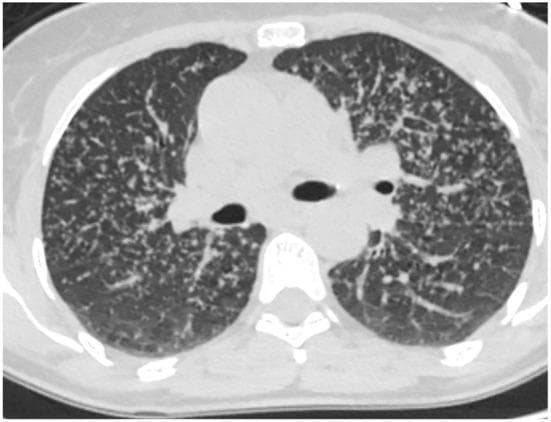 This diagnostic axial CT scan of the chest demonstrates non-fibrotic pulmonary sarcoidosis. The primary finding is a diffuse, bilateral distribution of small interstitial nodules. These nodules exhibit a characteristic perilymphatic pattern, localized prominently along the subpleural surfaces, interlobular septa, and the bronchovascular bundles. There is an absence of architectural distortion, honeycombing, or traction bronchiectasis, which distinguishes this as a non-fibrotic phase of the disease. The lung parenchyma between the nodules remains relatively clear, with no significant ground-glass opacities or consolidations visible. The central airways and hilar regions are depicted at this level, providing context for the nodular distribution relative to the major pulmonary vessels and bronchi. This image serves as a classic educational example of how lymphatic-related lung diseases like sarcoidosis manifest on high-resolution computed tomography (HRCT).