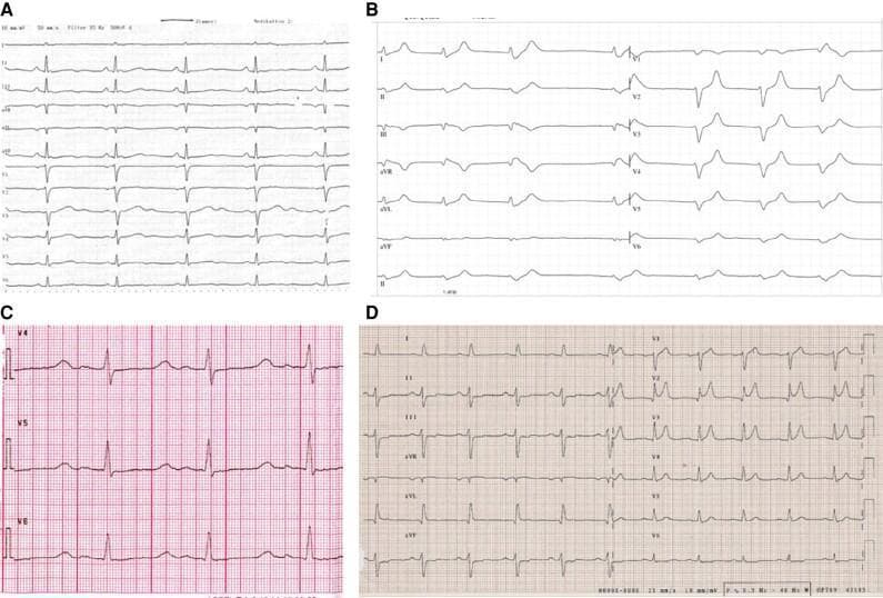 This diagnostic graphic illustrates various electrocardiogram (ECG) manifestations of electrolyte disturbances across four panels. Panel A demonstrates hypokalemia, characterized by flattened T waves and prominent U waves, which can lead to a pseudoprolonged QT interval. Panel B shows hyperkalemia, highlighted by classic tall, peaked 'tented' T waves and narrow QRS complexes. Panel C displays hypocalcemia, primarily showing a prolongation of the ST segment leading to a lengthened QT interval while T wave morphology remains relatively preserved. Panel D represents hypercalcemia, which is characterized by a shortened ST segment and a correspondingly shortened QT interval. The collection serves as an educational comparison chart for clinicians and medical students to recognize pathognomonic rhythm strip changes associated with potassium and calcium imbalances. Key educational concepts include repolarization abnormalities, interval duration changes, and the visual differentiation of metabolic derangements in a clinical cardiology context.