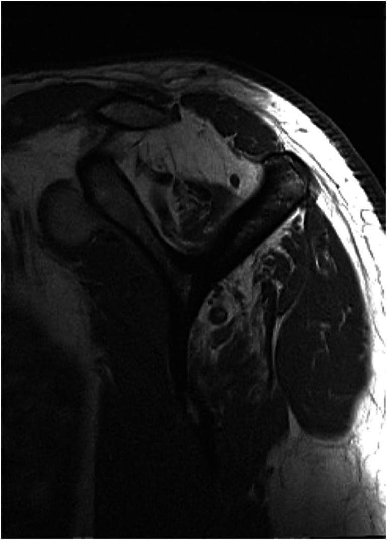 This diagnostic image is a T1-weighted parasagittal MR slice of the shoulder, specifically oriented to evaluate the rotator cuff musculature. The image demonstrates advanced fatty infiltration and muscular atrophy, critical for determining the reparability of chronic rotator cuff tears. The supraspinatus muscle shows a significant loss of muscle bulk (atrophy) and high signal intensity (hyperintensity), indicating replacement of muscle fibers by adipose tissue, consistent with a high Goutallier stage. Similarly, the infraspinatus muscle exhibits marked fatty degeneration. In contrast, the subscapularis and teres minor muscles maintain a normal, low-signal appearance (hypointense) relative to the fat, indicating preserved muscle quality without significant degeneration. This comparison serves as a key clinical indicator in orthopedic radiology for surgical planning and prognosis in patients with tendon pathology.