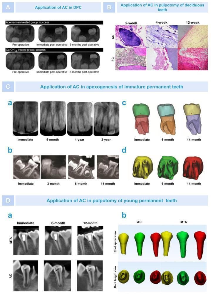 This composite educational image illustrates the clinical applications of Acemannan (AC) in regenerative endodontics, specifically for pulp-dentin complex regeneration. Section A presents comparative periapical radiographs showing successful direct pulp capping (DPC) results in AC-treated versus calcium hydroxide-treated groups. Section B displays histopathological images comparing AC and Formocresol (FC) in deciduous tooth pulpotomy at 2, 4, and 12-week intervals, highlighting tissue inflammatory response and dentin bridge formation. Section C focuses on apexogenesis in immature permanent teeth, utilizing a temporal series of radiographs (a, b) and 3D digital reconstructions (c, d) from immediate post-op to 2 years. These visuals demonstrate progressive root lengthening, dentinal wall thickening, and narrowing of the apical foramen. Section D compares AC and Mineral Trioxide Aggregate (MTA) in pulpotomy for young permanent teeth. Longitudinal X-rays (a) and 3D root reconstructions (b) track dentine bridge formation (indicated by black arrows) and continued apical development over 12 months. The image serves as a clinical reference for biomaterial efficacy in pediatric and regenerative dentistry.