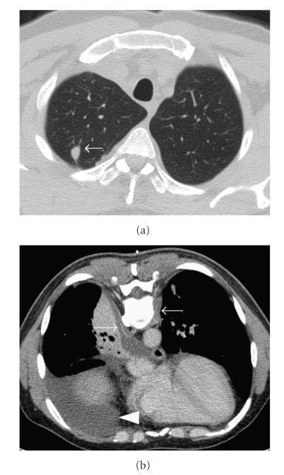 This diagnostic figure consists of two axial CT scan sections of the chest demonstrating pulmonary and pleural pathology. (a) A non-contrast axial CT in lung window settings reveals a discrete, approximately 1.5 cm nonspecific pulmonary nodule in the right upper lobe, indicated by a white arrow. The nodule is well-circumscribed and located within the peripheral lung parenchyma. (b) A contrast-enhanced axial CT scan performed in the prone position at the level of the 9th thoracic vertebra. It displays bilateral latero-spinal subpleural thickening (indicated by arrows) and a localized right-sided pleural effusion (indicated by a white arrowhead). The image demonstrates typical radiological findings associated with systemic inflammatory or granulomatous diseases such as Granulomatosis with Polyangiitis (GPA). These diagnostic images serve as an educational example of how multisystemic conditions present with varied intrathoracic manifestations, including parenchymal nodules and pleural involvement, requiring contrast-enhanced imaging for better soft tissue characterization.
