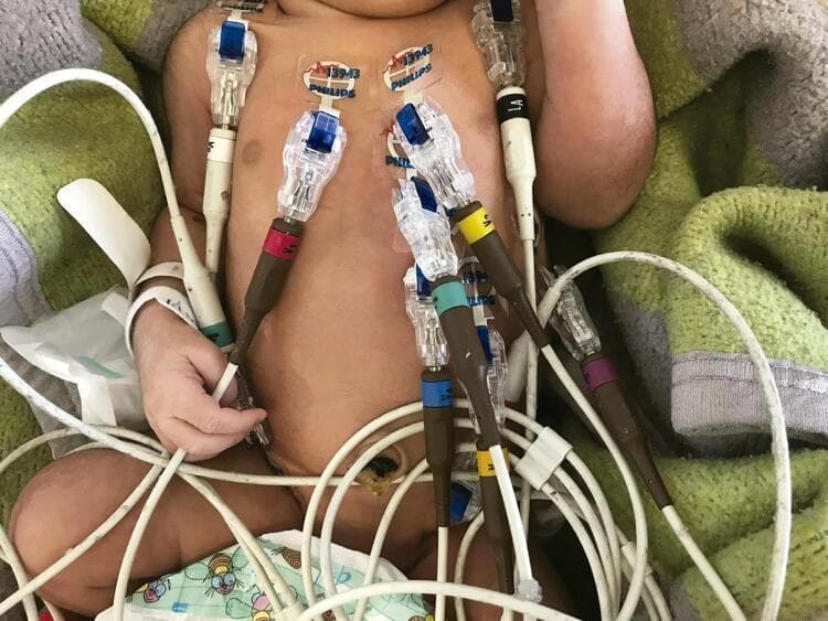 This clinical photograph demonstrates the specific electrode placement for a 12-lead electrocardiogram (ECG) on a neonate. To minimize motion artifact and signal noise common in newborns, the limb leads are repositioned: electrodes are placed on the right and left shoulders instead of the arms, and on the right and left iliac crests instead of the lower limbs. Precordial electrodes V1 through V6 are arranged across the anterior chest wall following standard anatomical landmarks. The image shows clear adhesive solid gel tab electrodes (Philips brand) connected via a system of color-coded brown 'grabber' style connectors (red, yellow, green, blue, and purple) to white insulated lead wires. This procedural setup illustrates specialized pediatric cardiovascular monitoring techniques designed to ensure high-quality diagnostic signals while accommodating neonatal anatomy and movement.