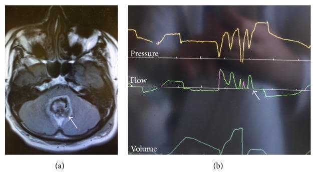A composite medical image featuring neuroimaging and ventilator waveforms. (a) Axial T2 Fluid Attenuated Inversion Recovery (FLAIR) MRI of the brain at the level of the posterior fossa. An arrow indicates a heterogeneous hyperintense area in the midline cerebellum, consistent with a status post-resection medulloblastoma. The pathology causes significant effacement and compression of the fourth ventricle. (b) Mechanical ventilator monitor display illustrating pressure, flow, and volume curves over time. The waveforms demonstrate a 'cluster breathing' pattern, characterized by irregular groups of rapid breaths followed by periods of apnea. This respiratory abnormality is a clinical sign of neurological injury, specifically involving the lower pons or medulla. The combination illustrates the correlation between structural brainstem compression in the posterior fossa and the resulting dysfunctional central respiratory drive.