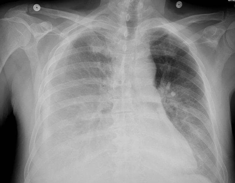 This anteroposterior (AP) chest X-ray demonstrates bilateral pleural effusions in a patient with a clinical history of renal cell carcinoma and recent pericardiocentesis. The right hemithorax shows a moderate-sized pleural effusion, evidenced by a significant homogenous opacity in the lower lung field with blunting of the costophrenic angle. Associated compressive atelectasis is visible in the adjacent right lung tissue. The left hemithorax exhibits a smaller, less pronounced pleural effusion with minimal blunting of the left costophrenic angle. The cardiac silhouette appears enlarged (cardiomegaly), consistent with the patient's recent history of large pericardial effusion. ECG leads are visible on the superior aspect of the chest, indicating active monitoring. The image illustrates typical radiographic findings of fluid accumulation within the pleural space and secondary parenchymal changes, serving as an educational example of postoperative or systemic disease complications in a critical care setting.