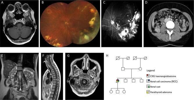 This composite figure illustrates the multi-system manifestations of Von Hippel-Lindau (VHL) disease through various imaging modalities. (A) Axial T1-weighted post-contrast MRI of the orbits demonstrates an intensely enhancing lesion in the left globe, consistent with a retinal hemangioblastoma. (B) Color fundus photograph of the left eye reveals peripheral chorioretinal scars from prior laser/cryotherapy, dragging of the optic nerve vessels, and active hemangiomas in the macula and nasal quadrants. (C) Fluorescein angiogram shows hyperfluorescence in areas of exudation and tractional retinal detachment. (D, E) Abdominal imaging via axial CT and coronal T2-weighted MRI displays a 29 mm right renal cell carcinoma (RCC) and bilateral numerous renal cysts. (F, G) Sagittal and axial post-contrast MRI of the spine and cervicomedullary junction highlight solid enhancing hemangioblastomas with associated feeding vessels on the dorsal spinal cord. (H) A family pedigree indicates the clinical history of a sporadic VHL case, including central nervous system hemangioblastomas, RCC, renal cysts, and parathyroid adenoma. This collection highlights the diagnostic features of VHL disease across ophthalmology, radiology, and genetics.