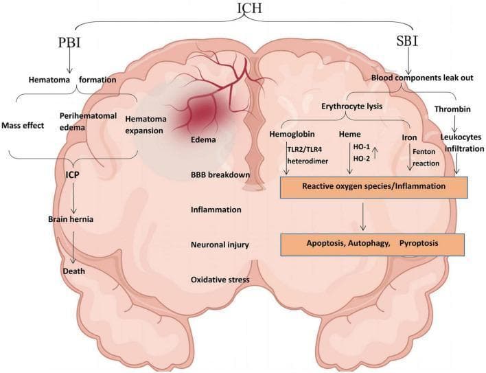 This pathophysiology diagram illustrates the dual pathways of Primary Brain Injury (PBI) and Secondary Brain Injury (SBI) following an Intracerebral Hemorrhage (ICH) within the human brain. The PBI pathway (left) focuses on mechanical complications: Hematoma formation leads to perihematomal edema and hematoma expansion, creating a mass effect. This causes increased Intracranial Pressure (ICP), leading to brain hernia and potentially death. The central region highlights shared pathological hallmarks, including blood-brain barrier (BBB) breakdown, edema, inflammation, neuronal injury, and oxidative stress. The SBI pathway (right) details biochemical cascades: blood leakage results in thrombin-mediated leukocyte infiltration and erythrocyte lysis. The lysis releases hemoglobin (activating TLR2/TLR4) and heme, which is processed by HO-1 and HO-2 into iron. Iron-driven Fenton reactions and hemoglobin activation contribute to a central node of reactive oxygen species (ROS) and inflammation. This cascade ultimately triggers cellular death mechanisms, including apoptosis, autophagy, and pyroptosis. The diagram serves as an educational summary of the complex interplay between mechanical pressure and neuroinflammatory cascades in hemorrhagic stroke.