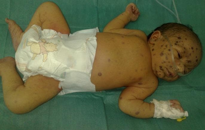 This clinical photograph shows a neonate exhibiting the classic presentation of 'blueberry muffin syndrome.' The image demonstrates numerous disseminated, non-blanching, violaceous to bluish-red macules, papules, and firm nodules. These cutaneous lesions are widely distributed across the infant's body, including the face, scalp, trunk, and extremities, with a high density particularly noted on the face and forehead. Such lesions represent extramedullary hematopoiesis and are classically associated with congenital infections (like Rubella, CMV, or Toxoplasmosis) or neonatal malignancies (such as neuroblastoma or leukemia). The infant is also seen with a nasal cannula and a peripheral intravenous line, indicating acute clinical care. This visual is an essential diagnostic example for pediatric dermatology and neonatology, illustrating the characteristic 'blueberry muffin' appearance used to trigger investigations into underlying systemic pathology.