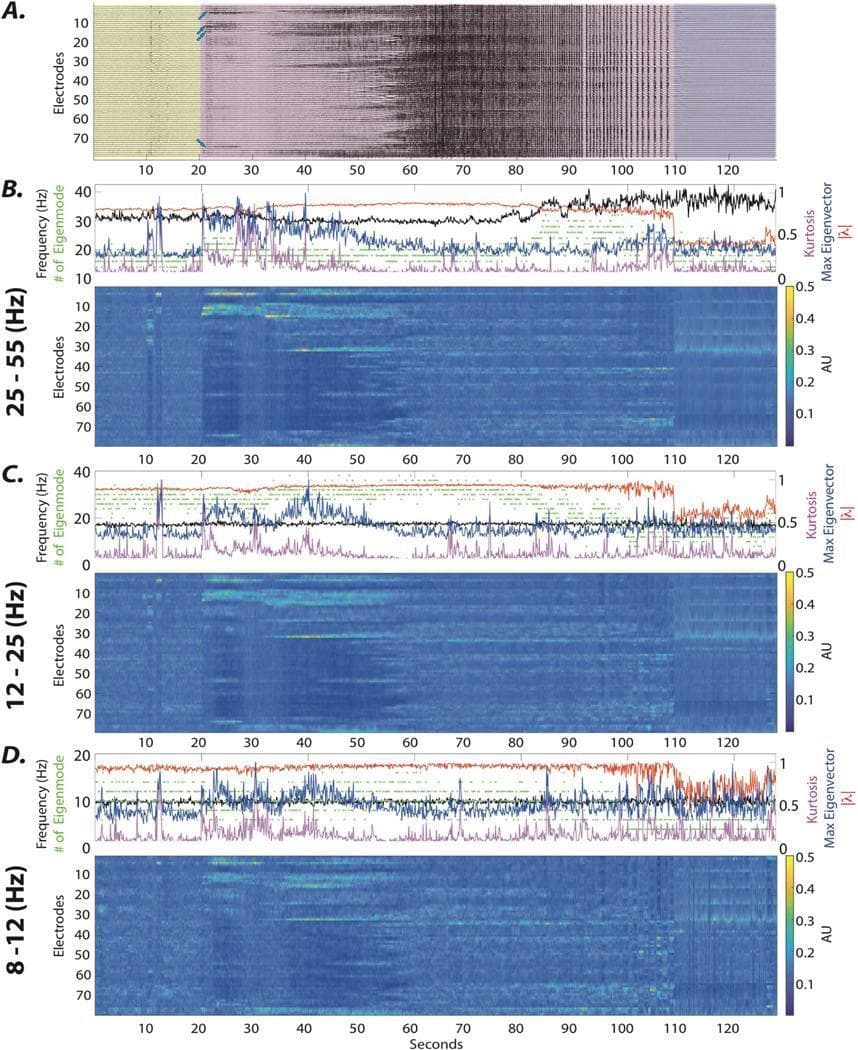 This figure demonstrates the spatiotemporal evolution of intracranial EEG (iEEG) signals and eigenmode dynamics during a focal seizure. Panel A displays raw iEEG signals from 79 electrodes over 130 seconds, categorized into pre-ictal (0–20s, yellow), ictal (20–110s, purple), and post-ictal (110–130s, gray) phases. Panels B, C, and D provide dynamical stability analysis across different frequency bands: gamma (γ, 25–55 Hz), beta (β, 12–25 Hz), and alpha (α, 8–12 Hz). Each section includes a line plot tracking maximum eigenvector values (blue), kurtosis (purple), eigenmode stability (red), and frequency (black). Below these are heatmaps representing the mean absolute value of eigenvectors across electrodes. The transition from pre-ictal to ictal is characterized by a time-locked increase in maximum eigenvector values and kurtosis, signifying the emergence of focal ictal sources. The heatmaps specifically visualize this focal loading on electrodes within the seizure onset zone (SOZ), illustrating how eigenmode decomposition can identify the spatial and spectral properties of evolving epileptic dynamics.