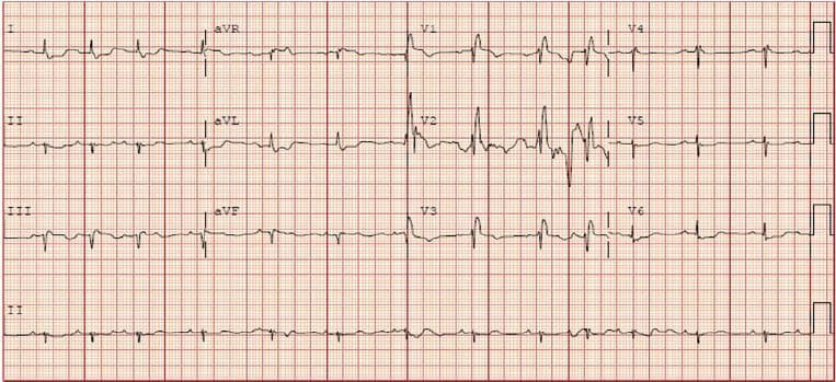 A 12-lead electrocardiogram (ECG) demonstrating findings consistent with right heart strain. The primary diagnostic features include a complete Right Bundle Branch Block (RBBB) and Right Axis Deviation (RAD). In the precordial leads V1-V3, the QRS complexes are widened with a classic RSR' pattern, most prominent in lead V1. Corresponding widened, slurred S waves are visible in leads I, aVL, and V6. In the limb leads, Right Axis Deviation is evidenced by a predominantly negative QRS complex in lead I and a predominantly positive QRS complex in lead aVF. There are additional signs of right ventricular strain, including T-wave inversions in the right precordial leads (V1-V3). These electrophysiological findings are clinically significant in the context of acute pulmonary hypertension, such as that caused by a massive pulmonary embolism. The ECG serves as an educational example of how acute right ventricular pressure overload manifests through conduction delays and axis shifts.