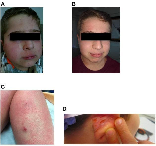 A multi-panel clinical photograph collection documenting atopic dermatitis (eczema) and treatment response. Panels A and B present a 'before and after' comparison of a pediatric patient's face. Panel A shows significant midfacial erythema, rough skin texture, and inflammatory papules on the cheeks and perioral region. Panel B demonstrates a marked reduction in inflammation and erythema with smoother skin texture following treatment with dupilumab. Panel C displays the right leg with diffuse, reticular erythema, xerosis, and a discrete inflammatory papule. Panel D shows the right ear with intense erythema, thickened skin, and visible fissuring or linear erosions. The images illustrate the clinical manifestations of severe eczema and its dermatological improvement under monoclonal antibody therapy (dupilumab), highlighting changes in skin morphology, color, and integrity across multiple anatomical regions.