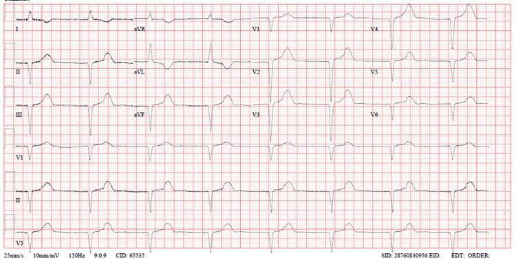 This diagnostic image is a 12-lead electrocardiogram (ECG) demonstrating a new-onset left bundle branch block (LBBB) pattern. The tracing shows a wide QRS complex (>120 ms) with characteristic morphology, including deep, broad S waves in the right precordial leads (V1-V3) and broad, notched, or monophasic R waves in the lateral leads (I, aVL, V5, and V6). Secondary ST-T wave changes are present, characterized by ST-segment elevation in leads V1-V3 and ST-segment depression with T-wave inversion in the lateral leads, which is discordant with the QRS polarity. These findings are critical in clinical cardiology for identifying intraventricular conduction delays and can mask or mimic myocardial infarction. The ECG provides educational value in recognizing the criteria for LBBB and understanding its implications in emergency clinical scenarios such as Takotsubo cardiomyopathy or acute coronary syndrome.