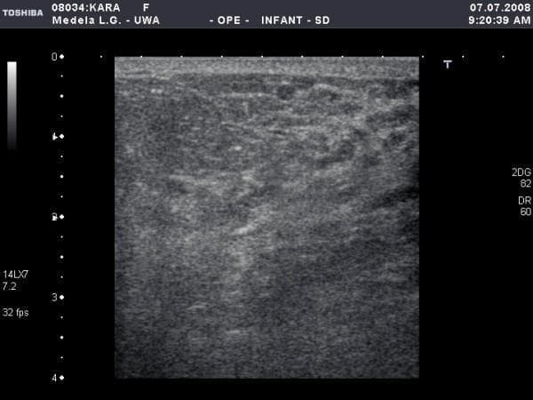 This diagnostic ultrasound image displays a radial or anti-radial section of a human lactating breast, specifically documented at the 12 o'clock position before a breastfeeding event. The image shows the characteristic heterogeneous echotexture of active mammary tissue. Prominent features include a dense, hyperechoic glandular parenchyma interspersed with darker, hypoechoic regions representing adipose tissue and small, branching milk ducts. Subtle linear hypoechoic structures are visible throughout the stroma, which correspond to non-distended lactiferous ducts. The subcutaneous fat layer and Cooper's ligaments contribute to the mixed echogenicity. This imaging provides educational value for understanding the normal physiological changes of the mammary gland during lactation, highlighting the increased glandular density and the presence of small, compressible ductal systems typical of a breast ready for milk ejection.