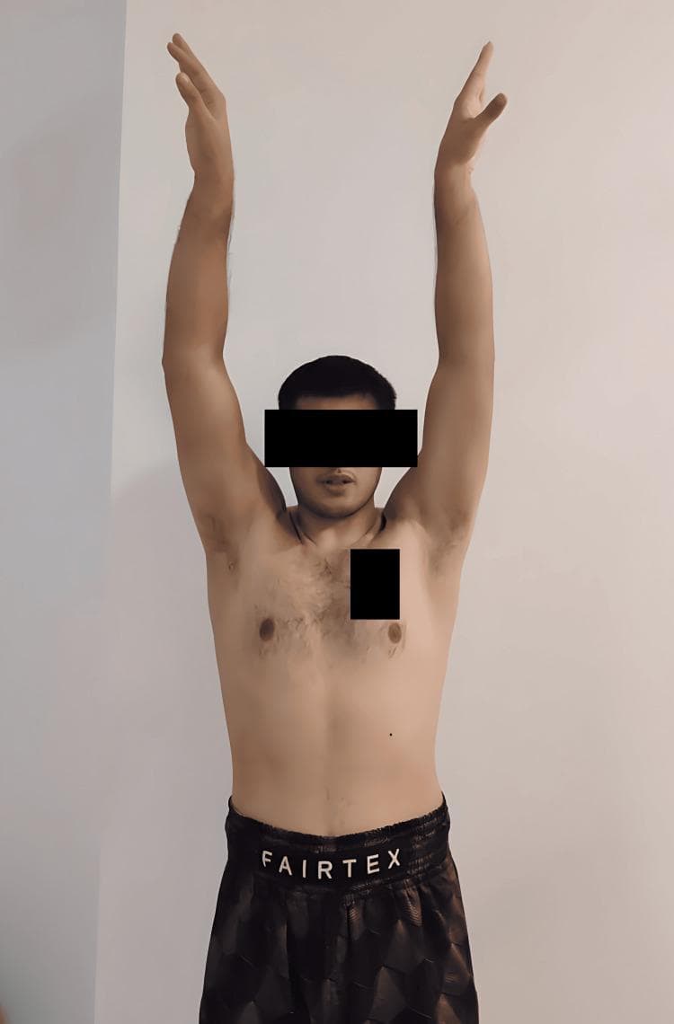 This clinical photograph shows the anterior view of a standing male patient one year following a bilateral open Latarjet procedure for recurrent shoulder dislocation. The patient is demonstrating active shoulder abduction, achieving a full range of motion (approximately 180 degrees) with both arms extended vertically overhead. The image illustrates a successful postoperative functional outcome following surgical stabilization for anterior shoulder instability, Bankart lesions, and Hill-Sachs defects. The patient exhibits a mesomorphic physique with well-healed surgical sites in the deltopectoral regions. This visual serves as a clinical assessment of joint mobility and muscle function in the context of orthopedic rehabilitation and sports medicine. Key educational concepts include the evaluation of postoperative glenohumeral stability and the restoration of athletic function in high-demand patients.