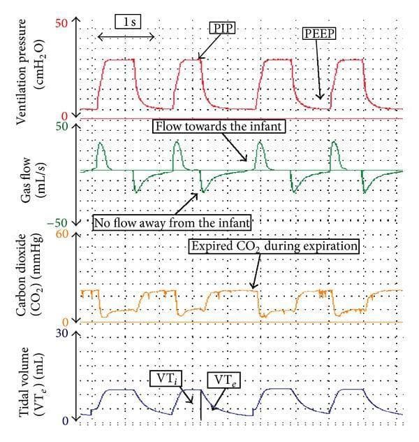 This diagnostic graphic displays synchronous respiratory function monitoring waveforms from a neonatal ventilator. It consists of four vertically stacked temporal traces: ventilation pressure (cmH2O), gas flow (mL/s), carbon dioxide (mmHg), and tidal volume (mL). The top pressure waveform illustrates positive pressure ventilation (PPV), identifying the Peak Inspiratory Pressure (PIP) during inflation and the Positive End-Expiratory Pressure (PEEP) at baseline. The gas flow waveform shows positive deflection during inspiration (flow towards the infant) and negative deflection during expiration (flow away). A capnography trace indicates expired CO2 peaks coinciding with the expiratory phase. The bottom waveform displays Tidal Volume (VT), showing increasing volume during inspiration (VTi) and decreasing volume during expiration (VTe). The return of the VT wave to the baseline without a residual offset indicates the absence of an endotracheal tube leak. This visualization is used in neonatal critical care to monitor lung mechanics, gas exchange efficiency, and circuit integrity during transport or bedside management.