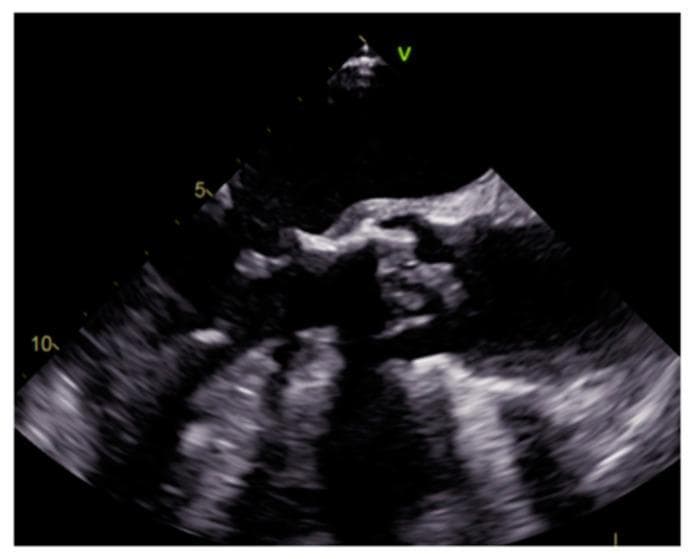 This diagnostic image is a transesophageal echocardiography (TEE) still frame demonstrating prosthetic aortic valve infective endocarditis. The visual focus is on the aortic valve region, where irregular, heterogeneously echogenic masses are visible, representing vegetations. These lesions exhibit lobulated contours and poorly defined borders, appearing more echogenic than the adjacent cardiac tissue. The vegetations are attached to the prosthetic valve leaflets or the perivalvular area, a hallmark of endocarditis in a prosthetic setting. The image is optimized for teaching the diagnostic criteria of infective endocarditis, specifically illustrating the morphology, echogenicity, and typical location of vegetations. The ultrasound highlights the contrast between the smooth, highly echogenic prosthetic material and the irregular, mobile-appearing infectious growths. This content is intended for advanced cardiology and radiology learners studying valvular heart disease and its complications.