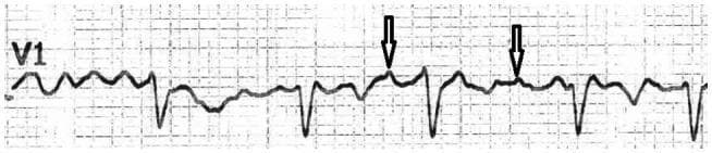 This diagnostic image shows a rhythm strip from an electrocardiogram (ECG) specifically recorded from lead V1. The tracing displays an irregular cardiac rhythm characteristic of atrial fibrillation. A key visual feature is the presence of coarse fibrillatory waves (F-waves), which are identified by vertical arrows. These coarse F-waves demonstrate an amplitude of ≥0.5 mm, creating a distinct, high-amplitude oscillatory baseline between the QRS complexes. The morphology of these waves is somewhat irregular and pointed compared to the smoother baseline oscillations seen in fine atrial fibrillation. The QRS complexes appear narrow and occur at irregular intervals (irregularly irregular), consistent with the underlying arrhythmia. This image serves as an educational example in cardiology for distinguishing coarse atrial fibrillation from other supraventricular tachyarrhythmias and for the quantification of fibrillatory wave voltage in clinical diagnostics.