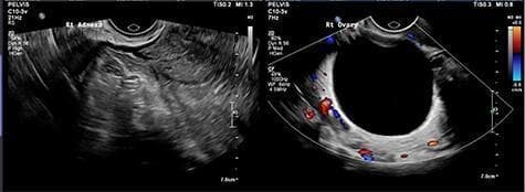 This diagnostic image consists of two side-by-side transvaginal ultrasound views of the pelvic region. The left panel shows the 'Rt Adnexa' with a heterogeneous, mixed echogenicity appearance, suggesting complex pathology such as a tubo-ovarian complex or hydrosalpinx. The right panel displays the 'Rt Ovary' using Color Doppler imaging, highlighting a large, unilocular, simple cyst. The cyst is characterized by its uniformly anechoic (black) internal fluid, well-defined smooth walls, and thin peripheral vascularization indicated by the red and blue Doppler signals. The comparison illustrates the visual difference between a simple ovarian cyst and complex adnexal structures. This material is suitable for medical education in obstetrics and gynecology, specifically for teaching sonographic identification of pelvic masses, ovarian cysts, and adnexal inflammation.