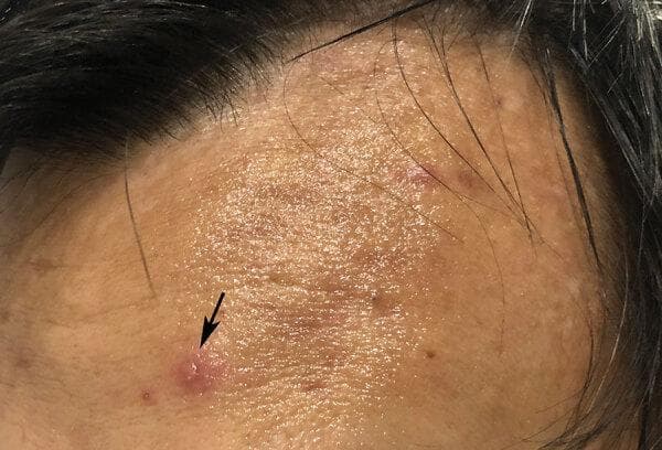 This clinical photograph shows a close-up of a patient's forehead, illustrating a hallmark dermatological sign of Varicella-Zoster Virus (chickenpox). The primary lesion, indicated by a black arrow, is a small, clear, fluid-filled vesicle situated atop a circular, erythematous base. This specific morphology is classically described in medical education as a 'dewdrop on a rose petal.' The surrounding skin displays secondary features including smaller, less defined erythematous papules and tiny hyperpigmented spots. The lesion is indicative of the early vesicular stage of a varicella infection, often preceded by systemic symptoms like fever. The photograph serves as an educational tool for recognizing primary skin lesions (vesicles), understanding their morphology, and identifying the clinical presentation of common viral exanthems in adult populations.