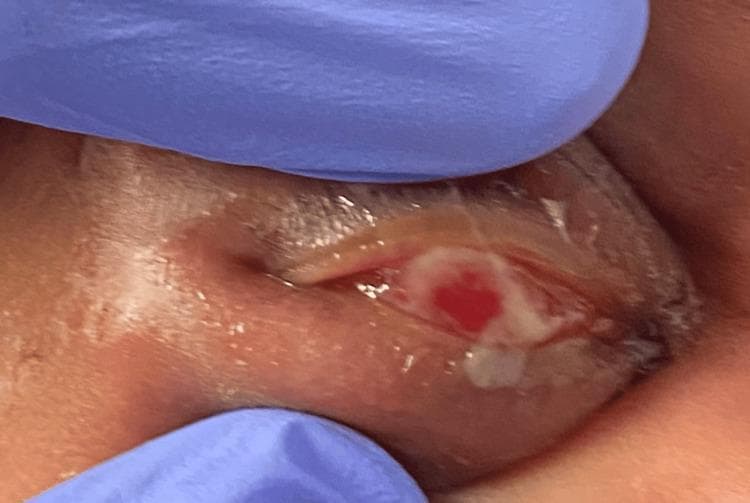 This clinical photograph displays a close-up, procedural view of the right eye of a neonate, with the upper eyelid everted by a clinician wearing blue nitrile gloves. The image demonstrates a primary clinical presentation of ophthalmia neonatorum (neonatal conjunctivitis). Significant findings include diffuse conjunctival injection (hyperemia) and a prominent accumulation of thick, yellowish mucopurulent discharge covering the palpebral and bulbar surfaces. The surrounding periorbital tissues and eyelids show marked erythema and edema. This visual illustrates the hallmark signs of infectious conjunctivitis in a newborn, highlighting the importance of assessing for N. gonorrhoeae or Chlamydia trachomatis. The photograph captures a key diagnostic step in the physical examination of a pediatric patient presenting with eye swelling and discharge, focusing on the character of the ocular secretion and the integrity of the ocular surface.