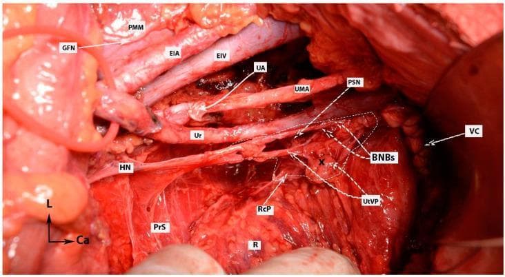 This clinical photograph provides a high-resolution surgical view of the pelvic retroperitoneal structures following a nerve-sparing radical hysterectomy. The image illustrates the complex neurovascular anatomy of the female pelvis, emphasizing the Inferior Hypogastric Plexus (IHP) and its branches. Major vascular landmarks include the external iliac artery (EIA) and vein (EIV) positioned superior-laterally, the umbilical artery (UMA), and the ligated uterine artery (UA). Critical neurological structures are meticulously exposed: the genitofemoral nerve (GFN) lies atop the psoas major muscle (PMM); the hypogastric nerve (HN) descends toward the presacral space (PrS); and the pelvic splanchnic nerves (PSN) contribute to the IHP. A primary educational focus is the preservation of the bladder nerve branches (BNBs), which are shown coursing toward the vaginal cuff (VC) and bladder base, lateral to the rectum (R) and the rectal plexus (RcP). The image demonstrates the anatomical relationships necessary for preserving autonomic function during oncological pelvic surgery, specifically identifying the distal ureter (Ur) and its proximity to the uterovaginal plexus (UtVP).