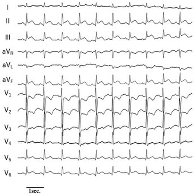 A diagnostic electrocardiogram (ECG) tracing displaying twelve leads arranged vertically from I to V6. The primary pathology is localized to the inferior leads (II, III, and aVF), which exhibit significant ST-segment elevation above the isoelectric line, merging into upright T waves. This finding is characteristic of an acute ST-elevation myocardial infarction (STEMI) involving the inferior wall of the myocardium. In the precordial leads (V1-V6), there is a progressive increase in R-wave amplitude from V1 through V4, followed by a slight decrease in V5 and V6. The QRS complexes in V1-V3 show sharp upward spikes, while V4-V6 display more rounded morphologies. Conversely, leads I, aVR, and aVL show relative ST-segment depression, which may represent reciprocal changes. The tracing demonstrates a regular rhythm with consistent QRS morphology across the cardiac cycles shown, serving as a classic clinical example for cardiology training and emergency medicine diagnostics.