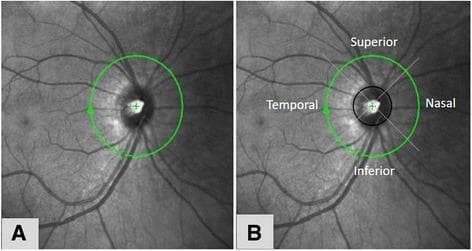 Diagnostic imaging showing fundus photographs with overlaid graphical markers for Retinal Nerve Fiber Layer (RNFL) measurement using Optical Coherence Tomography (OCT). Image A displays a green circular scan (peripapillary ring, typically 3.45 mm in diameter) centered on the optic disc, featuring a central crosshair and a directional arrow indicating the scan path. Image B adds an internal black circle delineating the optic disc margin and four diagonal lines that divide the peripapillary region into functional quadrants: superior, inferior, temporal, and nasal. The underlying anatomy shows the optic disc, emerging retinal vasculature, and subtle striations of the RNFL. This protocol is clinically used for quantifying nerve fiber loss in conditions such as glaucoma or diabetic retinopathy to assess neurodegeneration. The visualization demonstrates the methodology for regional thickness analysis relative to the optic nerve head.