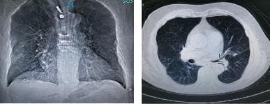 This diagnostic image pair displays thoracic radiology findings in an 80-year-old male with Chronic Obstructive Pulmonary Disease (COPD). The left panel shows a frontal chest radiograph (X-ray) exhibiting hallmark signs of hyperinflation, including a widened anteroposterior diameter and flattened diaphragmatic domes. Both lung fields demonstrate sparse bronchovascular markings and increased lucency, indicative of diffuse emphysema. The right panel shows an axial CT scan of the thorax, further characterizing the pulmonary pathology. It reveals significant emphysematous destruction of the lung parenchyma with the presence of multiple bullae and areas of decreased attenuation. Additionally, subtle interstitial lesions are visible. The imaging illustrates the classic presentation of severe COPD, characterized by permanent enlargement of airspaces distal to the terminal bronchioles and associated structural changes to the chest wall often described as a barrel chest.