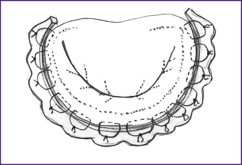 This medical illustration depicts an anatomical diagram of the mitral valve following a mitral valve plasty procedure for ischemic mitral regurgitation. The diagram focuses on the reinforcement of the annulus fibrosus using an autopericardial strip. The strip is positioned circumferentially along the posterior portion of the annulus, extending beyond the commissures to achieve annuloplasty and reduction of the valvular orifice. Multiple U-shaped sutures are visible, tied and evenly spaced along the outer perimeter of the strip, securing it to the underlying fibrous ring. Centrally, the valve leaflets are shown with a clear line of coaptation, indicating successful restoration of valve competence. Fine dotted lines and markings on the leaflet surfaces represent the structural integration and the satisfactory contact zone achieved post-correction. This illustration serves as an educational tool for cardiac surgery, demonstrating the surgical technique for autopericardial ring annuloplasty to treat valvular insufficiency.