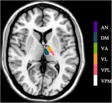 This diagnostic neuroimaging illustration features an axial T1-weighted Magnetic Resonance Imaging (MRI) slice of a human brain at the level of the basal ganglia and thalamus. The image serves as an anatomical diagram utilizing color-coded overlays to delineate standard thalamic subnuclei based on the Talairach template. Labeled subregions on the right thalamus include the Anterior Nucleus (AN) in purple, the Dorsomedial Nucleus (DM) in dark blue, the Ventral Anterior Nucleus (VA) in light green, the Ventral Lateral Nucleus (VL) in orange, the Ventral Posterior Lateral Nucleus (VPL) in pink, and the Ventral Posterior Medial Nucleus (VPM) in white. The spatial arrangement demonstrates the anteroposterior and mediolateral organization of these nuclei, illustrating the complex internal architecture of the thalamus. This visual resource is designed for advanced neuroanatomical education and radiologic training, highlighting specific functional zones within the diencephalon that are critical for sensory relay, motor integration, and limbic processing.