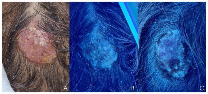 Clinical and diagnostic images illustrating tinea capitis progressing to kerion, caused by Microsporum canis. Panel A displays a clinical photograph of the scalp featuring a well-circumscribed, solitary inflammatory mass. The lesion is characterized by significant alopecia, erythema, an eroded surface, and yellowish crusting, consistent with a kerion. Panels B and C demonstrate Wood’s lamp examinations of the same area. Panel B shows a characteristic bright, intense blue-greenish fluorescence across the entire lesion, a pathognomonic finding for certain ectothrix fungal infections like M. canis. Panel C displays the same lesion after two weeks of fluconazole treatment, showing a significant reduction in fluorescence intensity and area, indicating therapeutic response and a decrease in fungal load. This sequence is used for medical education to demonstrate clinical diagnosis, diagnostic imaging using ultraviolet light (Wood’s lamp), and the objective monitoring of treatment efficacy in inflammatory fungal infections of the scalp.
