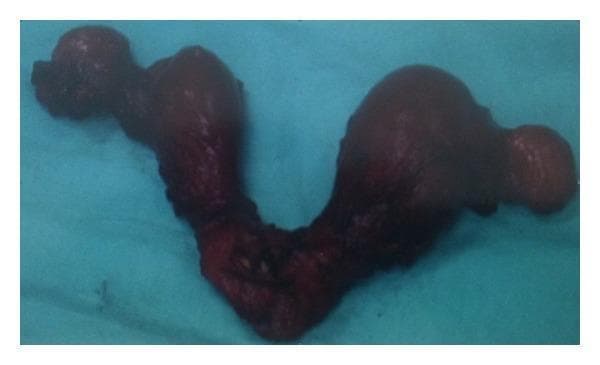 This clinical photograph shows a posterior view of a gross pathological specimen of a didelphys uterus. The image displays a complete Müllerian duct anomaly characterized by two entirely separate uterine bodies (horns), each with its own fundus, resulting in a distinct 'V' or bilobed shape. The specimen appears as dark, reddish-brown tissue against a blue surgical drape. The morphology demonstrates total non-fusion of the paramesonephric ducts, leading to the formation of two distinct uterine cavities and two cervices, which converge at a common lower point. The surface of the tissue is irregular and nodular, particularly in the fundal regions, which is consistent with the clinical diagnosis of uterine carcinosarcoma in one of the horns. This visual serves as a clear educational example of a Class III Müllerian duct anomaly (uterine didelphys) and its associated pathological findings.