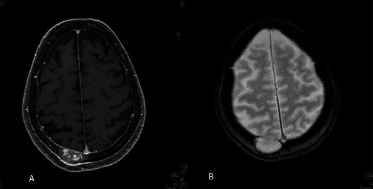 This diagnostic image consists of two axial MRI slices of the head, labeled A and B, illustrating a prominent osteolytic lesion of the right posterior parietal skull vault. Image A is a T1-weighted sequence showing a heterogeneous, predominantly hypointense lesion measuring 34 x 17 mm in the transverse plane. There is visible peripheral enhancement along the inner table, suggesting dural or pachymeningeal involvement. Image B is a T2-weighted sequence where the lesion appears markedly hyperintense relative to the brain parenchyma. The mass demonstrates full-thickness erosion of the skull vault with focal inward bulging into the epidural space. Notably, there is no evidence of underlying brain parenchymal edema or cortical signal abnormality, indicating the lesion remains extradural without pial passage. These images are characteristic of calvarial tumors or inflammatory processes (such as eosinophilic granuloma or metastatic disease) requiring multiplanar evaluation to assess dural integrity and intracranial extension.