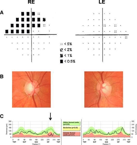 This composite ophthalmological diagnostic image presents the clinical findings of Juvenile Open-Angle Glaucoma (JOAG) in a comparison of the right eye (RE) and left eye (LE). Panel A displays Humphrey visual field pattern deviation maps, showing a dense superior arcuate defect involving fixation in the right eye, while the left eye remains relatively clear. Panel B contains color fundus photographs of the optic discs; the right disc shows an inferotemporal notch and a subtle disc hemorrhage, with both eyes exhibiting significant glaucomatous cupping. Panel C illustrates Optical Coherence Tomography (OCT) retinal nerve fiber layer (RNFL) thickness profiles. The right eye demonstrates significant thinning in the inferior quadrant (indicated by a black arrow), with the profile falling into the red 'Outside Normal Limits' (p < 0.01) zone. The left eye shows better preservation of the RNFL, though some thinning is present. Collectively, these images illustrate asymmetric glaucomatous optic neuropathy and the correlation between structural nerve fiber loss and functional visual field defects.