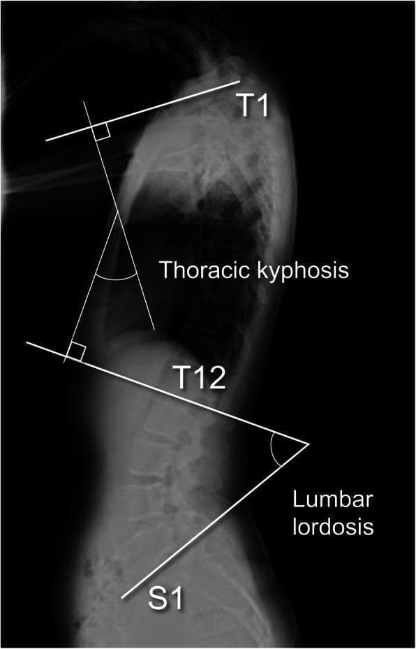 This diagnostic sagittal X-ray (radiograph) of the thoracolumbar spine illustrates the radiographic measurement techniques for sagittal spinal alignment parameters. The image demonstrates two primary spinal curves: thoracic kyphosis and lumbar lordosis. Thoracic kyphosis (TK) is visually defined using the Cobb method, where lines are drawn parallel to the superior endplate of the T1 vertebra and the inferior endplate of the T12 vertebra; the angle formed by the intersection of perpendicular lines from these boundaries quantifies the posterior convexity of the thoracic region. Inferiorly, lumbar lordosis (LL) is measured as the angle between a line drawn along the inferior endplate of T12 and a line along the superior endplate of S1, representing the anterior convexity of the lumbar spine. This clinical imaging is essential for orthopedic and neurosurgical evaluation of sagittal balance, spinal deformities, and preoperative planning. The labeling identifies the key anatomical landmarks (T1, T12, S1) and the resulting angular measurements, providing a clear educational overview of spinopelvic sagittal alignment assessment.