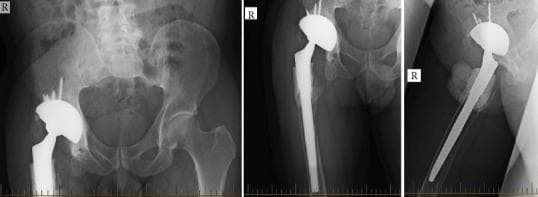 This composite of three diagnostic X-ray radiographs (anteroposterior, lateral, and oblique views) displays a right total hip arthroplasty (THA) following revision surgery. The imaging demonstrates a complex tripolar prosthesis designed for dual mobility and constraint. The acetabular component consists of a radiopaque multi-hole metallic shell securely fixed with several superiorly-directed orthopedic screws. A distinctive radiopaque mantle indicates that a revision liner has been cemented into the primary shell. The femoral component features a long, straight revision stem extending deep into the femoral shaft. A visible radiopaque halo surrounding the proximal femoral stem and within the acetabular interface is consistent with antibiotic-impregnated bone cement (PMMA) used for fixation and dead-space management. The femoral head is concentrically reduced within the dual-mobility liner. Clinically, this construct is utilized in complex revision cases involving gluteal deficiency, chronic instability, or periprosthetic infection to maximize range of motion while minimizing the risk of recurrent dislocation.
