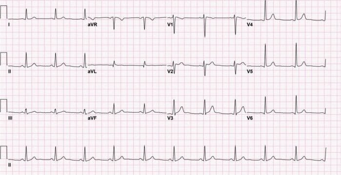 This diagnostic image is a standard 12-lead electrocardiogram (ECG) displayed on a pink grid background. The tracing demonstrates a regular normal sinus rhythm with clearly visible P waves preceding each QRS complex. The QRS complexes are narrow and exhibit normal morphology across the limb leads (I, II, III, aVR, aVL, aVF) and precordial leads (V1-V6). Lead aVR shows an expected global inversion of the P, QRS, and T waves. In the precordial leads, there is a normal progression of R-wave amplitude from V1 to V6, with the S-wave amplitude decreasing accordingly. The ST segments are predominantly isoelectric, showing a resolution of prior significant ST-segment elevation. Minor J-point elevation is noted in leads V1 and V2, though the characteristic 'coved' type 1 Brugada pattern is no longer prominent. T waves are upright in the majority of leads, particularly the lateral precordial leads (V4-V6). This ECG serves as a clinical example of the pharmacological reversal or resolution of a drug-induced Brugada phenocopy following the discontinuation of inciting medications like lamotrigine.