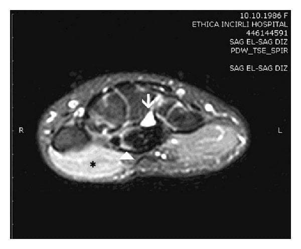 This diagnostic image is a fat-suppressed proton density (PD) axial MRI of the wrist, highlighting the carpal tunnel anatomy and associated pathology. The image demonstrates a high-signal intensity space-occupying lesion (marked by a white arrow) located within the carpal tunnel, consistent with a cystic mass such as a ganglion. The median nerve (indicated by a white arrowhead) shows increased signal intensity and morphological flattening, suggestive of compressive neuropathy or carpal tunnel syndrome. Additionally, there is a prominent area of high signal intensity within the thenar muscles (marked by an asterisk), which is visually distinct from the lower signal of adjacent musculature. This feature is a classic radiological sign of acute muscle denervation resulting from median nerve compromise. The image serves as an educational example of secondary carpal tunnel syndrome, illustrating the relationship between an anatomical obstruction, nerve inflammation, and the subsequent neuromuscular impact on the thenar eminence.