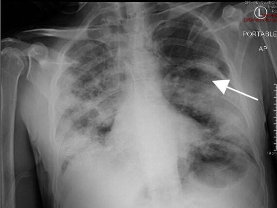 This diagnostic image is a portable anteroposterior (AP) chest radiograph illustrating the status of a patient following the treatment of a tension pneumothorax. A chest tube is visible in the left hemithorax, appropriately positioned within the pleural space. A prominent white arrow in the mid-to-upper left lung field points toward the visceral pleural line, indicating significant lung re-expansion towards the chest wall. Both lung fields exhibit diffuse, bilateral, patchy opacities and infiltrates, most prominent in the middle and lower zones, suggestive of underlying parenchymal disease or acute respiratory distress. The mediastinal contour appears stable post-decompression. This radiograph serves as a clinical example of the immediate radiological improvement and lung re-inflation achieved after emergent needle decompression and subsequent tube thoracostomy for tension pneumothorax. The image is highly relevant for medical education concerning emergency medicine, pulmonology, and critical care imaging.