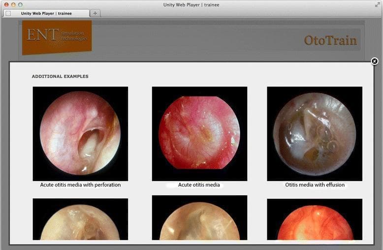 A comparison chart of otoscopic diagnostic images from a medical simulator, focusing on pathologies of the tympanic membrane (TM). The visual contains three labeled primary circular otoscopic views: 1) 'Acute otitis media with perforation,' showing an inflamed, erythematous TM with a large, irregular central perforation through which the middle ear space is visible; 2) 'Acute otitis media,' depicting an intensely hyperemic, opaque, and bulging TM with loss of normal landmarks and light reflex; and 3) 'Otitis media with effusion,' illustrating a translucent, amber-colored TM with visible air-fluid levels and bubbles in the middle ear space. These clinical photographs serve as educational examples for ENT trainees to differentiate between infectious stages (AOM) and non-purulent fluid accumulation (OME). The interface includes secondary supportive images below each category to demonstrate variability in presentation. This content is designed for medical students and residents to master diagnostic otoscopy and middle ear pathology recognition.