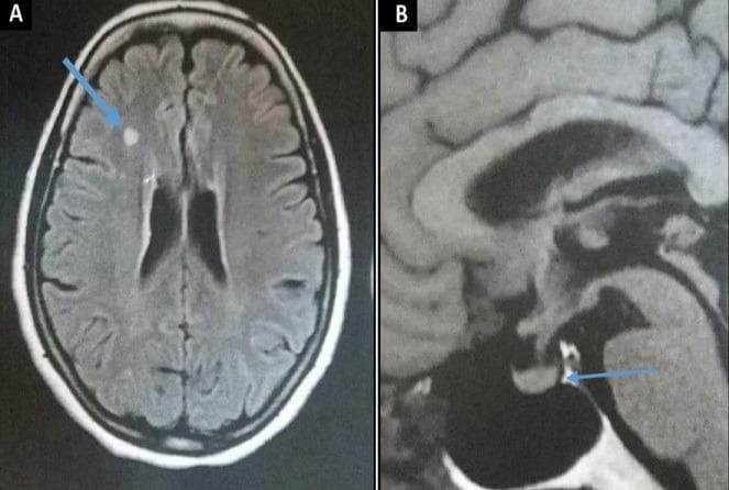 This composite diagnostic image features two MRI sequences of the brain in a patient diagnosed with Erdheim-Chester disease. Panel A is an axial Fluid-Attenuated Inversion Recovery (FLAIR) MRI showing a discrete, nodular hyperintensity within the subcortical white matter of the right frontal lobe (indicated by a blue arrow). Panel B is a midline sagittal T1-weighted MRI focusing on the sella turcica and hypothalamo-pituitary axis. The blue arrow in Panel B highlights the pathological loss of the normal physiological hyperintense signal (the posterior pituitary 'bright spot') within the neurohypophysis, a finding often associated with central diabetes insipidus. The pituitary stalk appears normal in morphology without thickening. These neuroimaging findings demonstrate the multi-systemic central nervous system involvement of Erdheim-Chester disease, specifically manifesting as white matter parenchymal lesions and hypothalamic-pituitary infiltration.